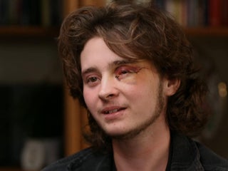 21-year-old says he's blind in left eye after federal agent shot him with  less-lethal round at California protest - CBS News