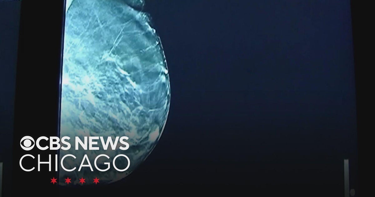 AI mammogram screening can help catch aggressive breast cancer earlier