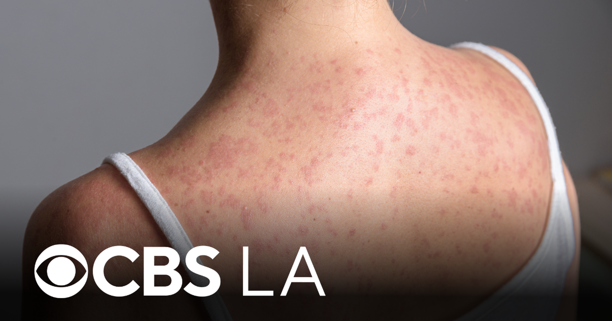 Second measles case connected to Disneyland visitor reported by Orange County officials