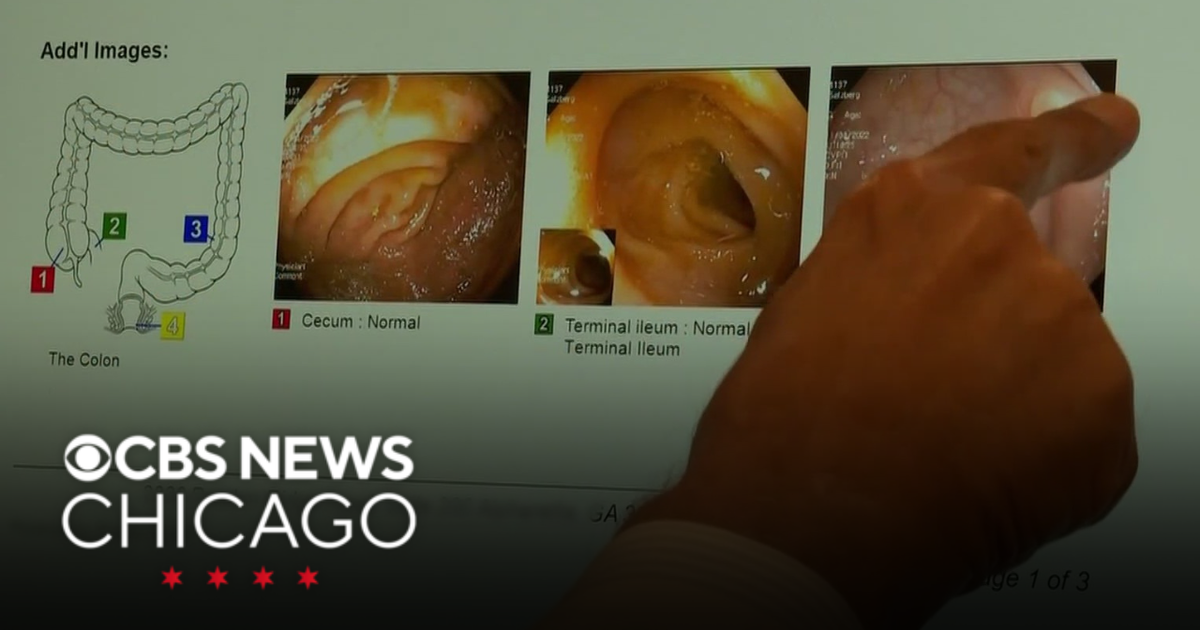 Health experts share 5 warning signs of colorectal cancer | Health Watch