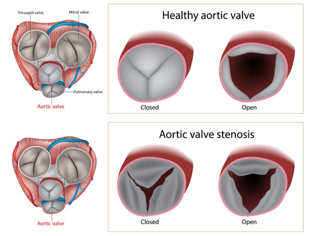 Aortic valve stenosis and Healthy aortic valve. Valvular heart disease.