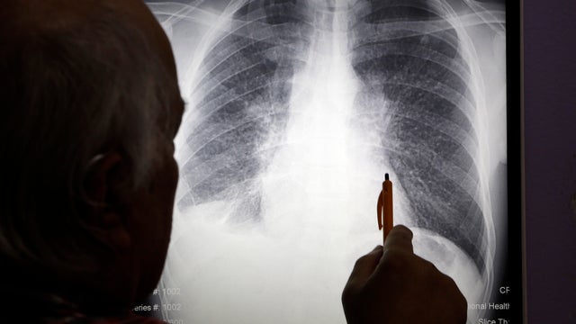 Doctor looks at an X-ray of a patient's lungs 