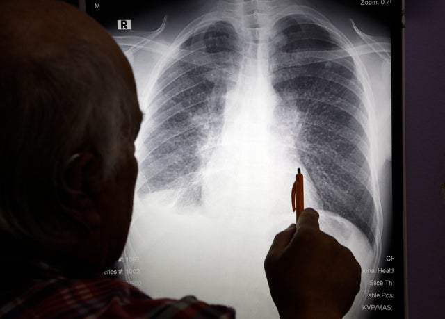 Silicosis, Lung Disease Once Linked to Mining, Hits Workers in Countertops Industry