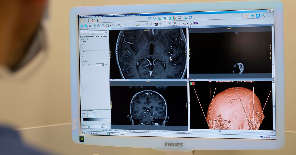 Deep brain stimulation helps South Florida Parkinson’s patient regain control after years of tremors