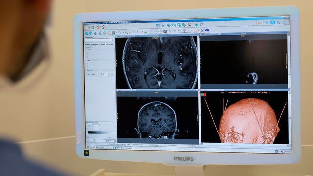 Deep Brain Stimulation 