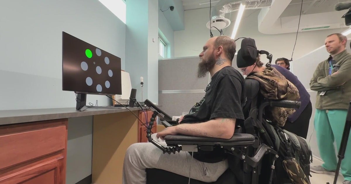 Colorado surgery first to implant higher-level brain computer interface ...