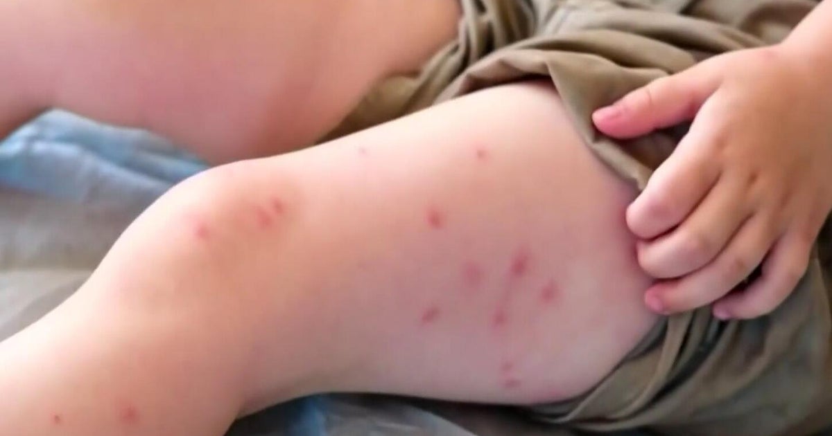 Sacramento-area parents say theyre going to be more cautious amid rise in measles cases