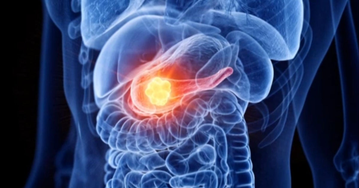 High hopes for new pancreatic cancer therapies