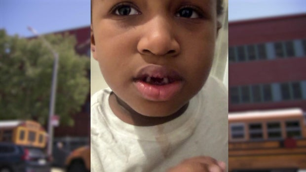 5-year-old with missing teeth and blood stain on shirt 