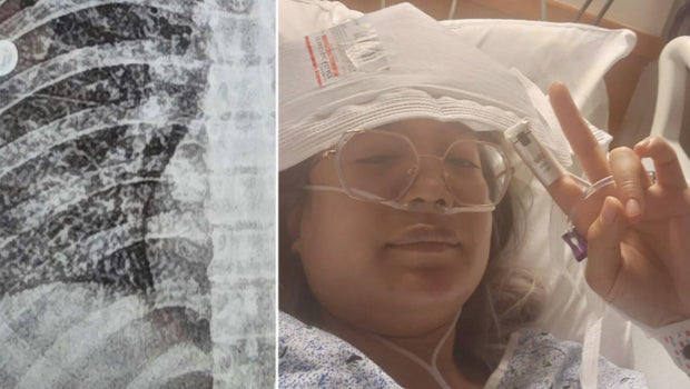 Philadelphia-area woman with rare lung disease determined to participate in Lung Force Walk