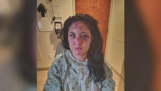 cbsmiami-mimai-attack-survivor-1.jpg 
