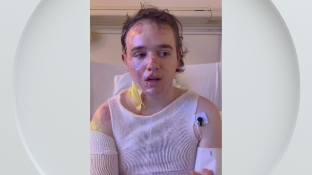 yuba-city-mcdonalds-worker-burned.png 