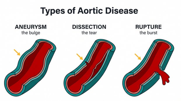 Sen. Lindsey Graham just died of aorta disease. My husband did too.