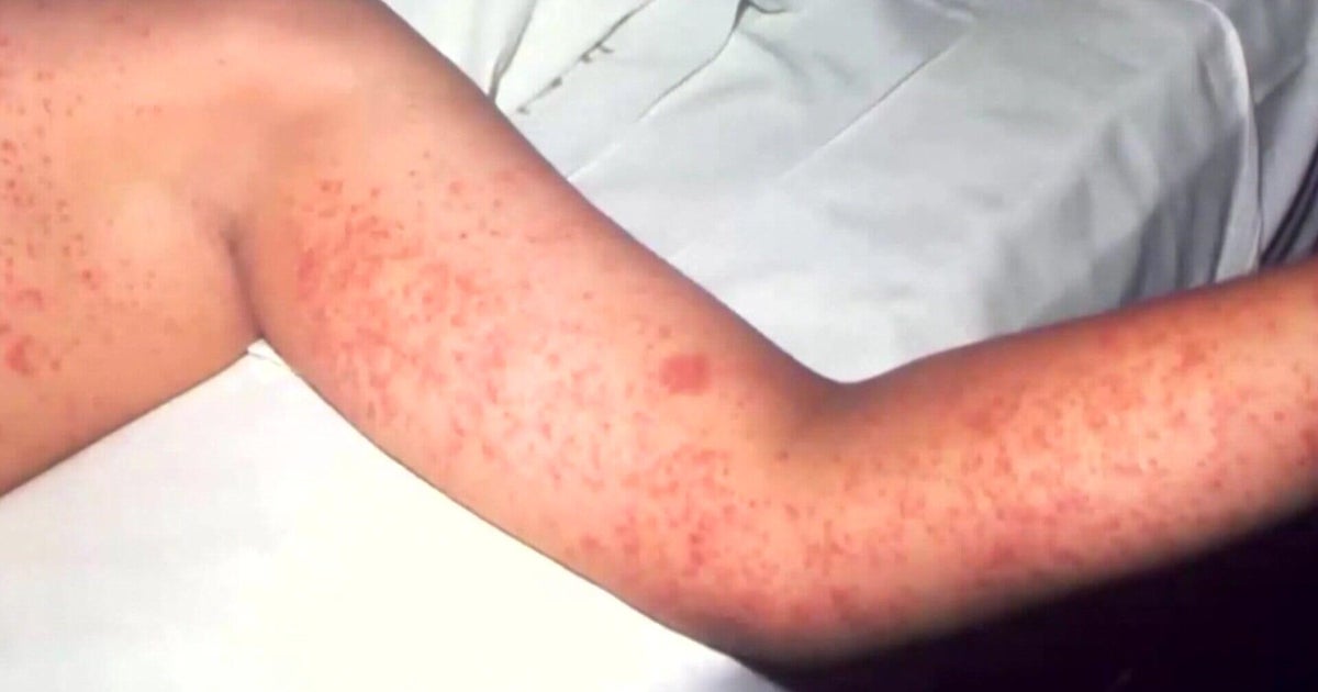 UC Davis doctor urges vaccinations as California measles cases double