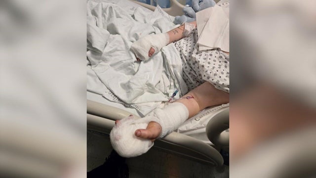 Kaitlynn Berman in hospital bed with injuries to her arms and hands 