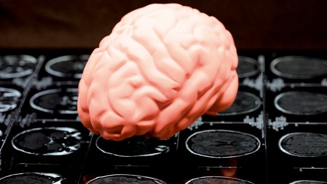 Traumatic brain injury Xray and model 