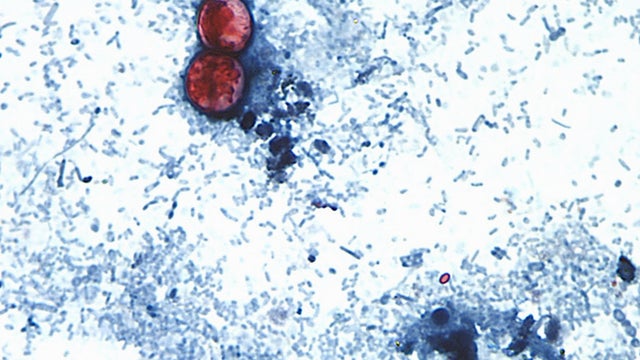 Cyclospora Outbreak 