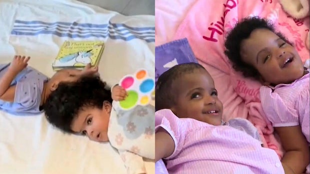 cbsn-fusion-doctors-successfully-separate-twin-girls-conjoined-head-thumbnail.jpg