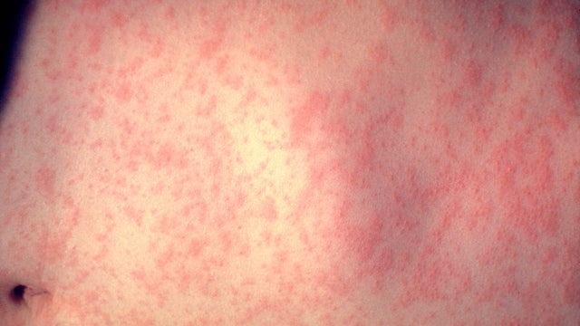 Measles Outbreaks Spread In U.S. 