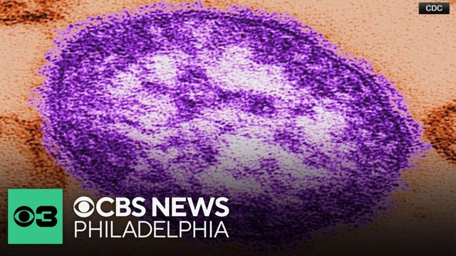 Doctors expect measles cases in Pennsylvania to increase amid outbreak