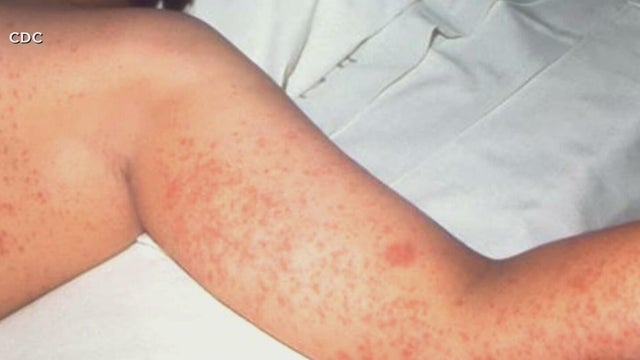 6th measles-associated death reported in Pennsylvania, officials say
