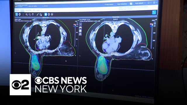 New weapon against breast cancer uses AI to make radiation more precise