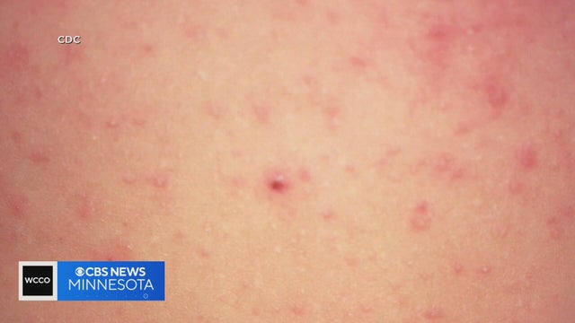 25 cases of measles identified in central, southeastern Minnesota, MDH says