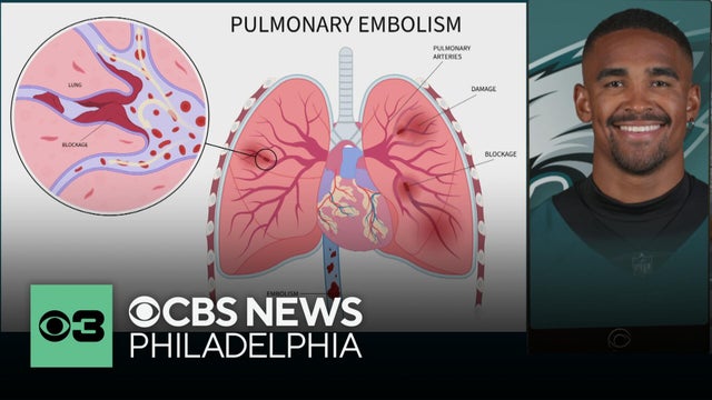 Doctor explains Jalen Hurts' condition: what is a pulmonary embolism and how is it treated?