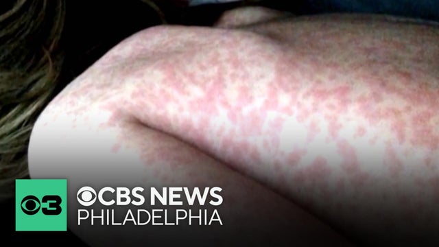 CDC sends disease detective to Pennsylvania to investigate measles outbreak