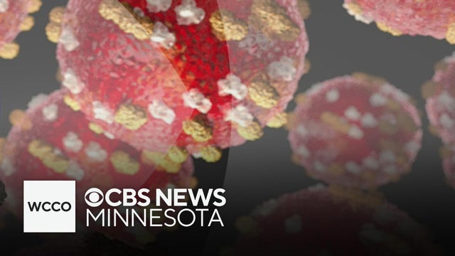 Minnesota's measles case count hits 36-year high