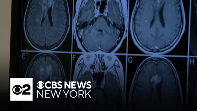 New study finds more than 70% of former nfl players who died over 15 year span may have had CTE